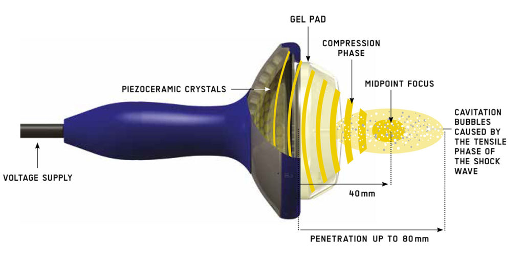 Pistola para o tratamento por ondas de choque  que serve para tendinite calcária